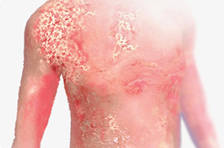 CONTROLLING GPP FLARES