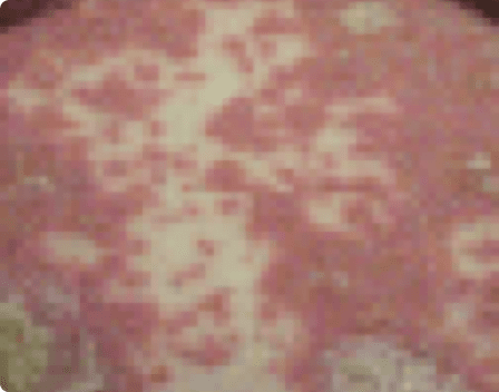 flares of Generalized pustular psoriasis 2