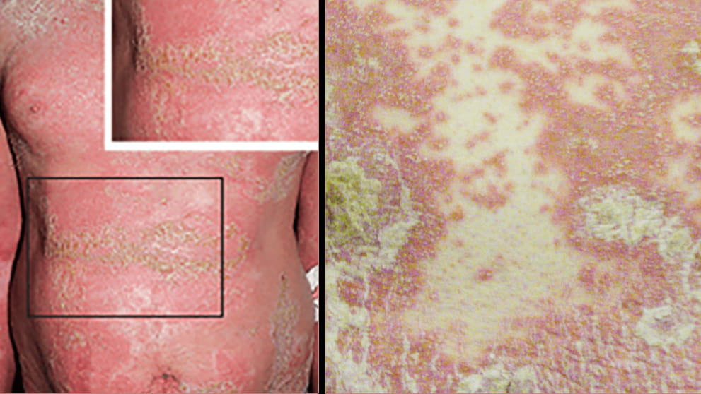 flares of Generalized pustular psoriasis